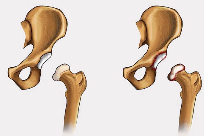 alterações degenerativas e dor na articulação do quadril