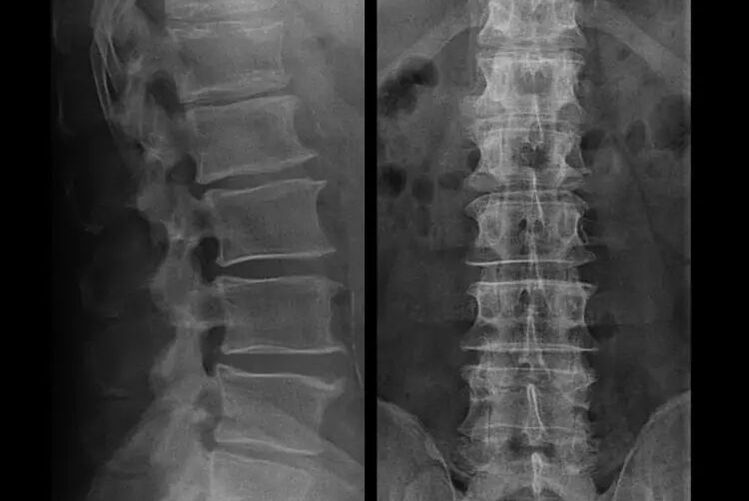 osteocondrose na radiografia