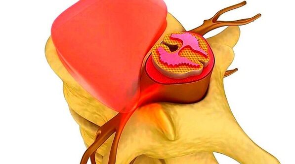 osteocondrose da coluna torácica a essência da doença