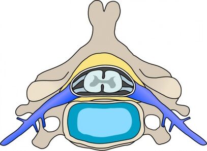 Protabius na vértebra com osteocondrose cervical